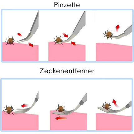 Edelstahl Zeckenzange